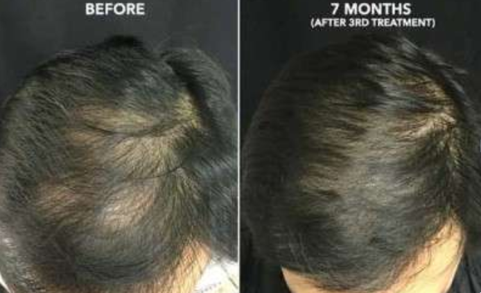 IS PRP Hair Treatment a Performed Solution?