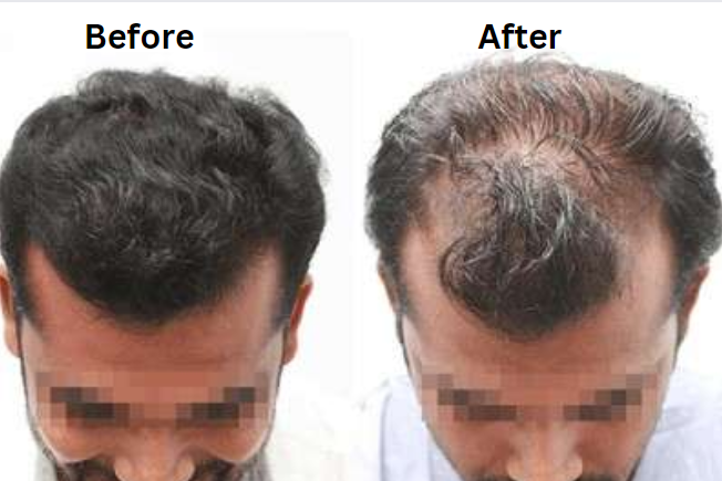 How Much Does Hair Transplant Cost in Men?
