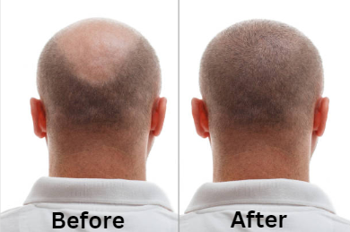 After Hair Transplant: Does It Look Natural?