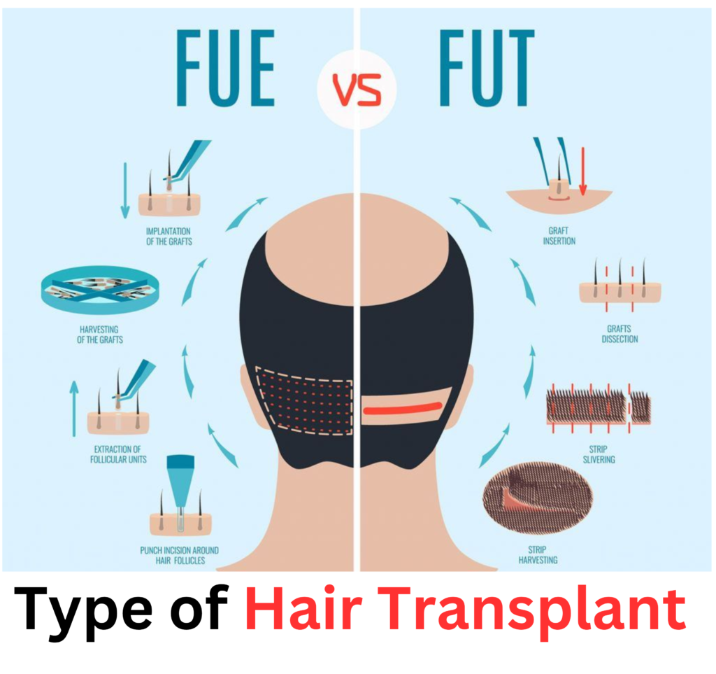 Bangalore offers cutting-edge hair transplantation procedures, with two primary techniques: