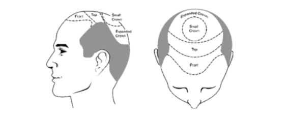 Understand the Various Factors that affect the Hair Transplant Cost in Kerala 