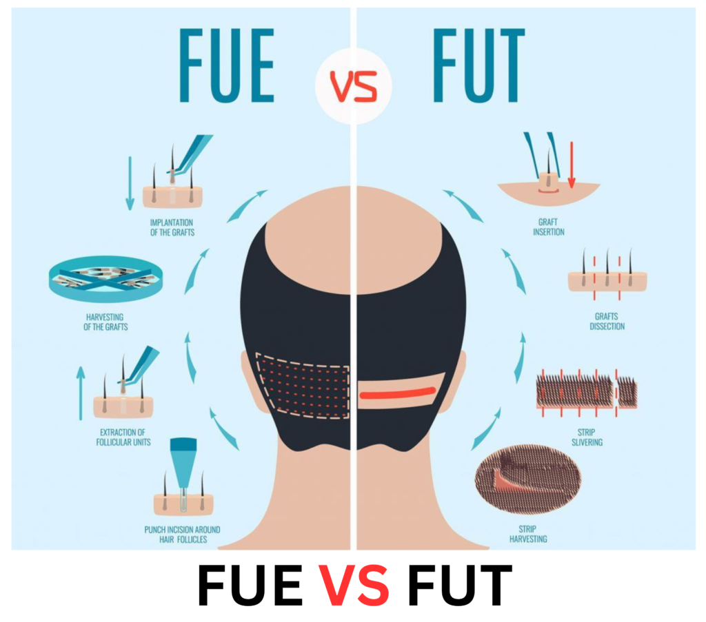 The two essential techniques are Follicular Unit Transplantation (FUT) and Follicular Unit Extraction (FUE).