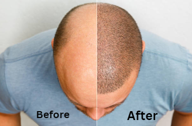 Hair Transplant cost In india
