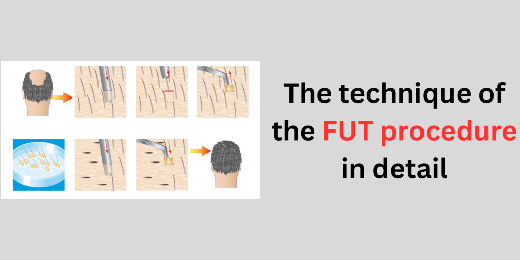 The technique of the FUT procedure in detail