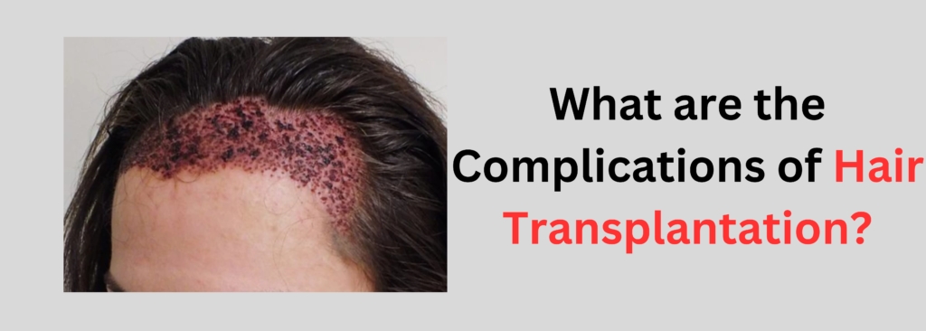 What are the Complications of Hair Transplantation?