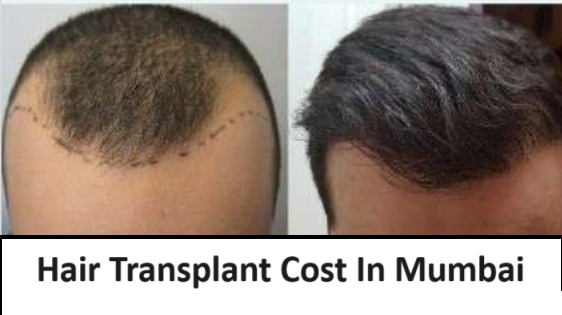Hair Transplant Cost In Mumbai