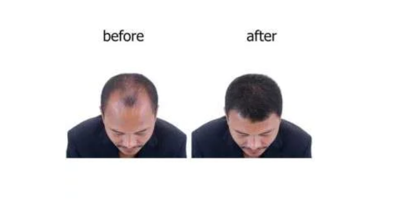  Few Benefits for Approaching Us For Hair Restoration
