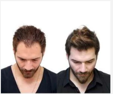 What is the process for FUT hair transplants?