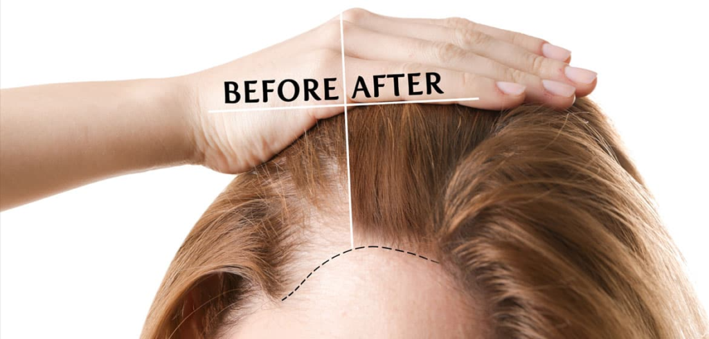 What are the Conditions where Hair Transplant Can be done in Females?