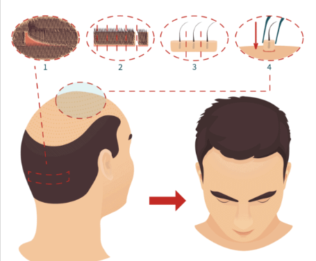 The Procedure of Hair Transplant
